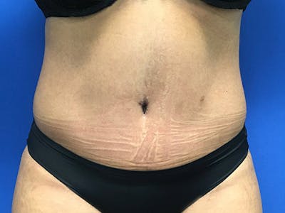 Tummy Tuck (Abdominoplasty) Before & After Gallery - Patient 102905473 - Image 2