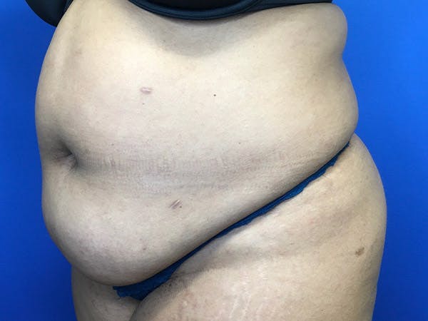 Tummy Tuck (Abdominoplasty) Gallery - Patient 102905473 - Image 3