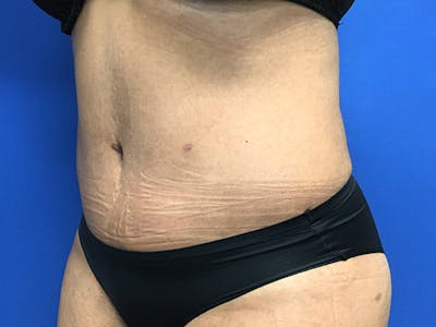 Liposuction Before & After Gallery - Patient 102905461 - Image 4