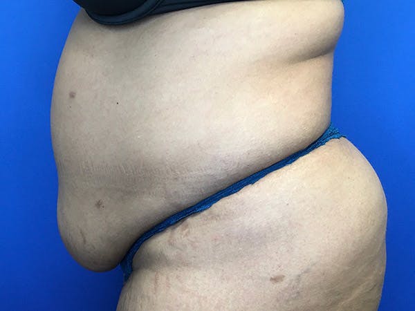 Tummy Tuck (Abdominoplasty) Before & After Gallery - Patient 102905473 - Image 5