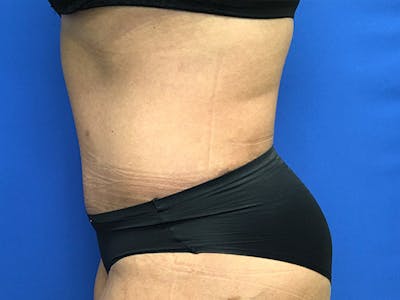 Liposuction Gallery - Patient 102905461 - Image 6
