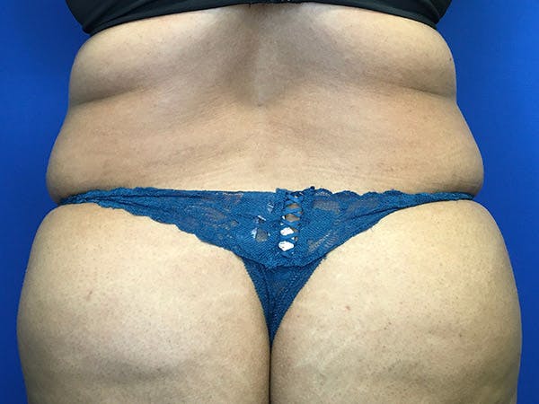 Liposuction Before & After Gallery - Patient 102905461 - Image 7