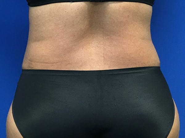 Liposuction Before & After Gallery - Patient 102905461 - Image 8