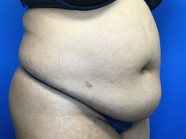 Liposuction Before & After Gallery - Patient 102905461 - Image 9