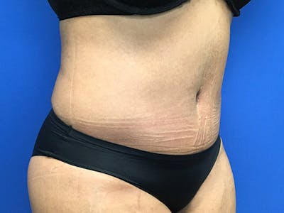 Liposuction Before & After Gallery - Patient 102905461 - Image 10