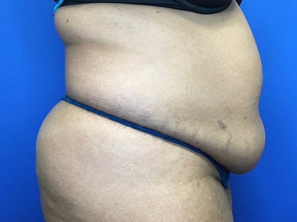 Liposuction Before & After Gallery - Patient 102905461 - Image 11