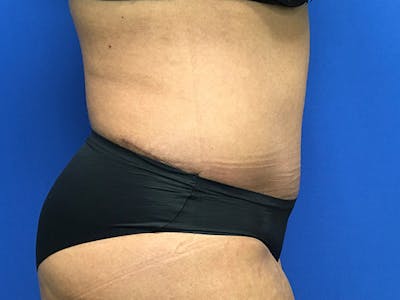 Liposuction Gallery - Patient 102905461 - Image 12