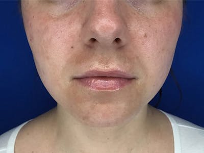 Lip Fillers Before & After Gallery - Patient 105876884 - Image 1