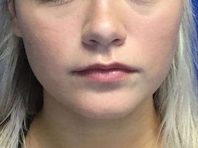 Lip Fillers Before & After Gallery - Patient 105876885 - Image 1