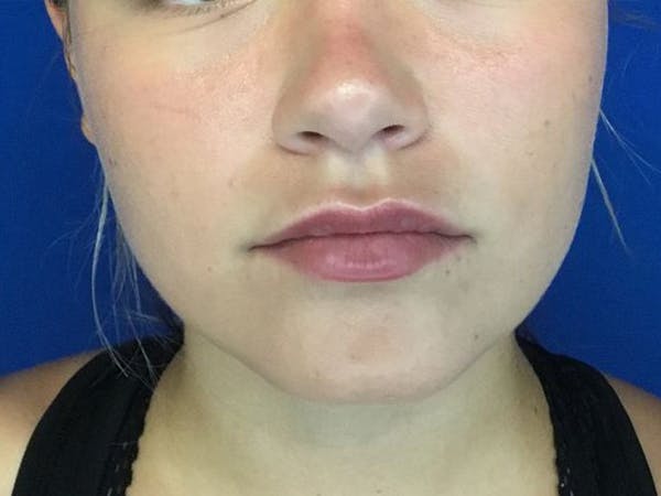 Injectable Fillers Before & After Gallery - Patient 105876885 - Image 2