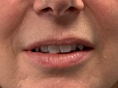 Lip Fillers Before & After Gallery - Patient 105877754 - Image 1