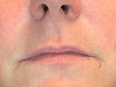 Lip Fillers Before & After Gallery - Patient 105877755 - Image 1