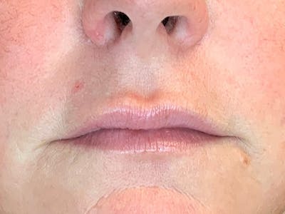 Injectable Fillers Before & After Gallery - Patient 105877755 - Image 2