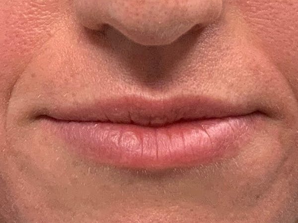 Lip Fillers Before & After Gallery - Patient 105877756 - Image 1