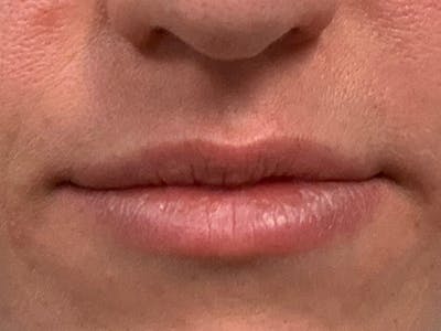 Lip Fillers Before & After Gallery - Patient 105877756 - Image 2