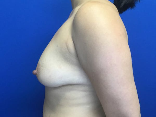 Mastopexy Before & After Gallery - Patient 106040760 - Image 3