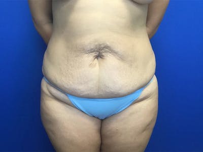 Liposuction Before & After Gallery - Patient 106041012 - Image 1