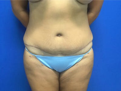 Liposuction Before & After Gallery - Patient 106041012 - Image 2