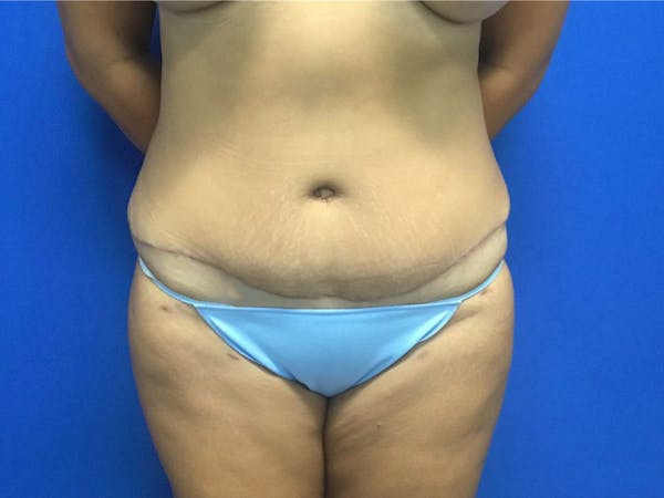Tummy Tuck (Abdominoplasty) Before & After Gallery - Patient 106041008 - Image 2