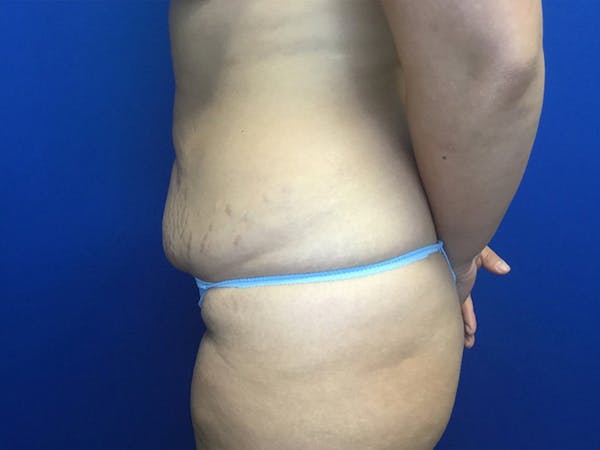 Liposuction Before & After Gallery - Patient 106041012 - Image 3