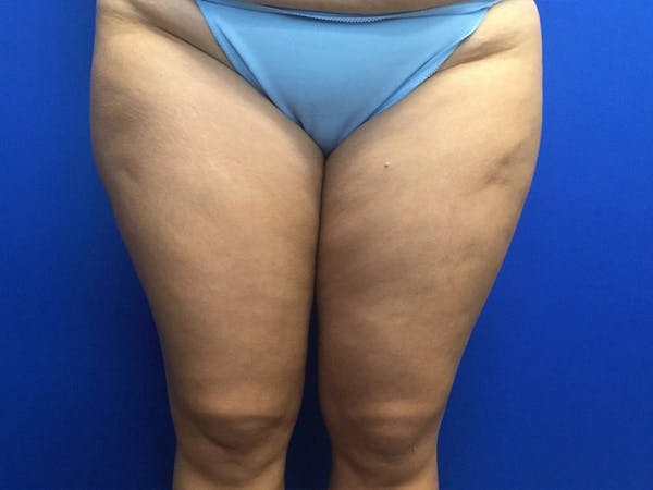 Liposuction Before & After Gallery - Patient 106041012 - Image 5