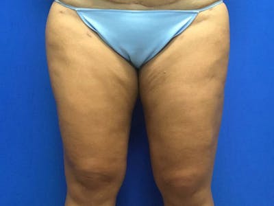 Liposuction Before & After Gallery - Patient 106041012 - Image 6
