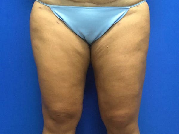 Liposuction Before & After Gallery - Patient 106041012 - Image 6