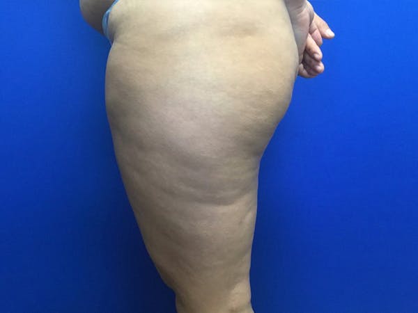 Liposuction Before & After Gallery - Patient 106041012 - Image 7