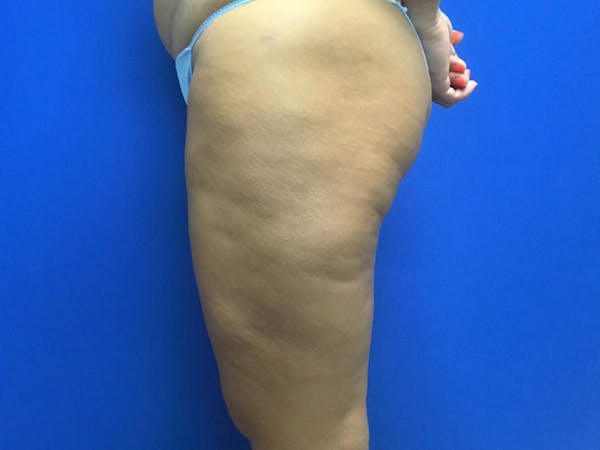 Liposuction Before & After Gallery - Patient 106041012 - Image 8