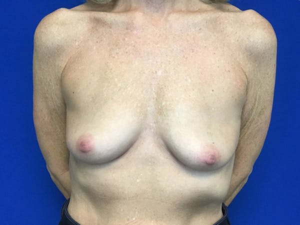 Breast Augmentation Gallery - Patient 106946156 - Image 1