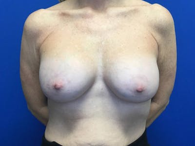 Mastopexy Before & After Gallery - Patient 106946159 - Image 2