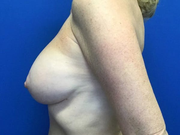 Mastopexy Before & After Gallery - Patient 106946159 - Image 4
