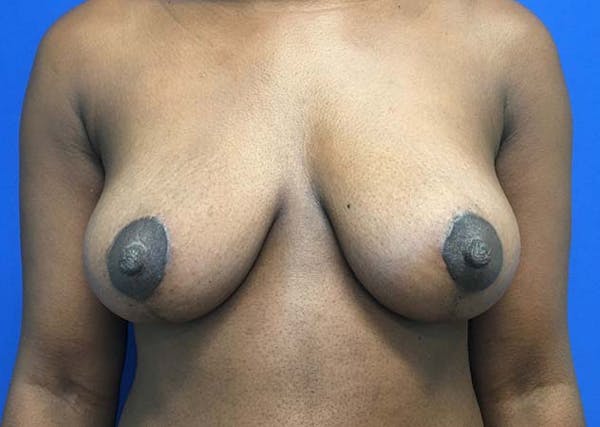 Mastopexy Before & After Gallery - Patient 121376070 - Image 2