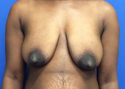 Mastopexy Before & After Gallery - Patient 121376070 - Image 1