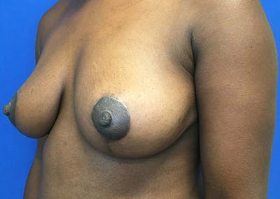 Mastopexy Before & After Gallery - Patient 121376070 - Image 4