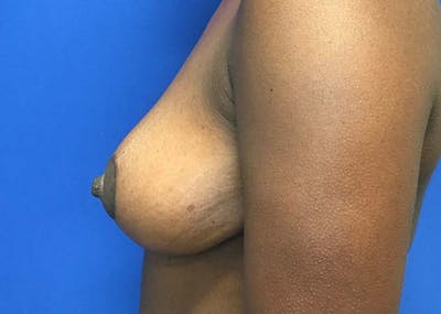 Mastopexy Before & After Gallery - Patient 121376070 - Image 6