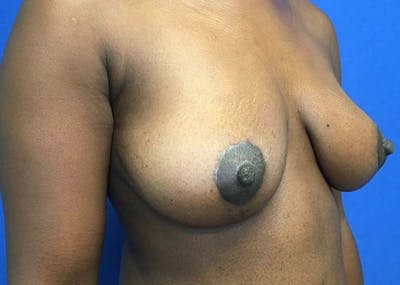 Mastopexy Before & After Gallery - Patient 121376070 - Image 8