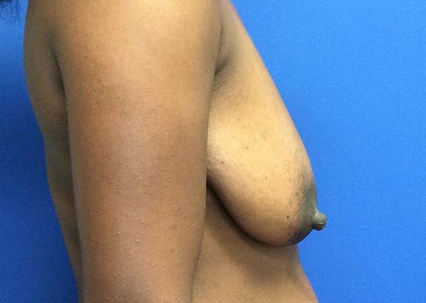 Mastopexy Before & After Gallery - Patient 121376070 - Image 9
