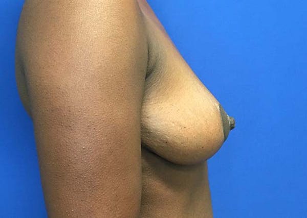 Mastopexy Before & After Gallery - Patient 121376070 - Image 10