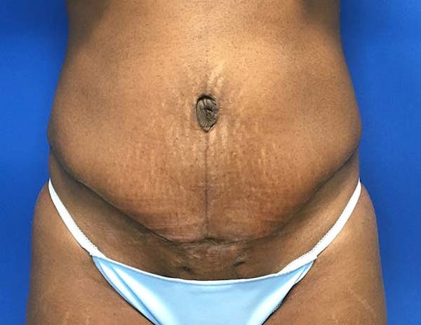 Tummy Tuck (Abdominoplasty) Before & After Gallery - Patient 121376483 - Image 2