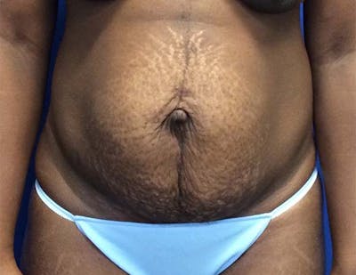 Tummy Tuck (Abdominoplasty) Gallery - Patient 121376483 - Image 1