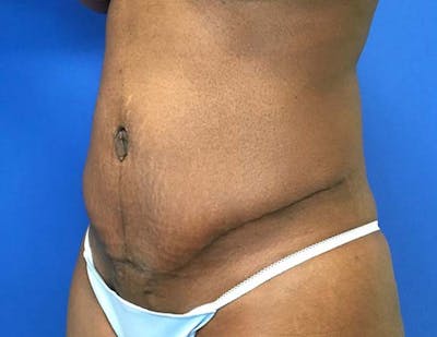 Tummy Tuck (Abdominoplasty) Gallery - Patient 121376483 - Image 4