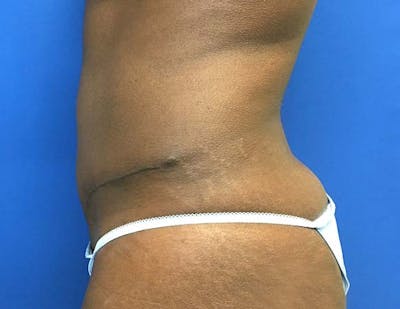 Tummy Tuck (Abdominoplasty) Gallery - Patient 121376483 - Image 6