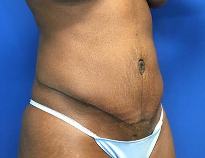 Tummy Tuck (Abdominoplasty) Before & After Gallery - Patient 121376483 - Image 8