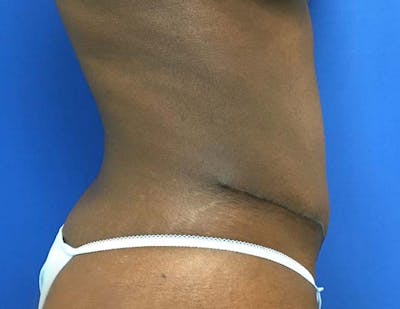 Tummy Tuck (Abdominoplasty) Before & After Gallery - Patient 121376483 - Image 10