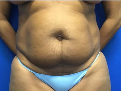Tummy Tuck (Abdominoplasty) Gallery - Patient 121378349 - Image 1
