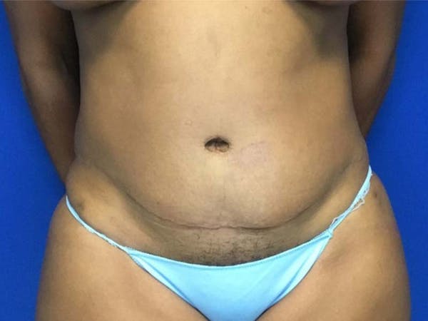 Liposuction Before & After Gallery - Patient 121378348 - Image 2