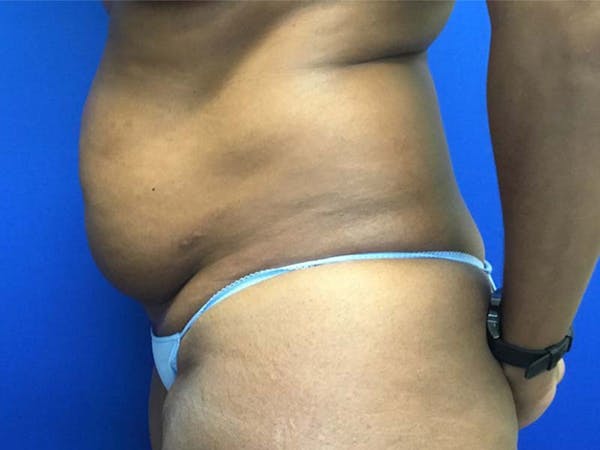 Liposuction Before & After Gallery - Patient 121378348 - Image 3