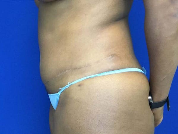 Tummy Tuck (Abdominoplasty) Before & After Gallery - Patient 121378349 - Image 4