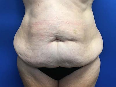 Tummy Tuck (Abdominoplasty) Before & After Gallery - Patient 121562692 - Image 1